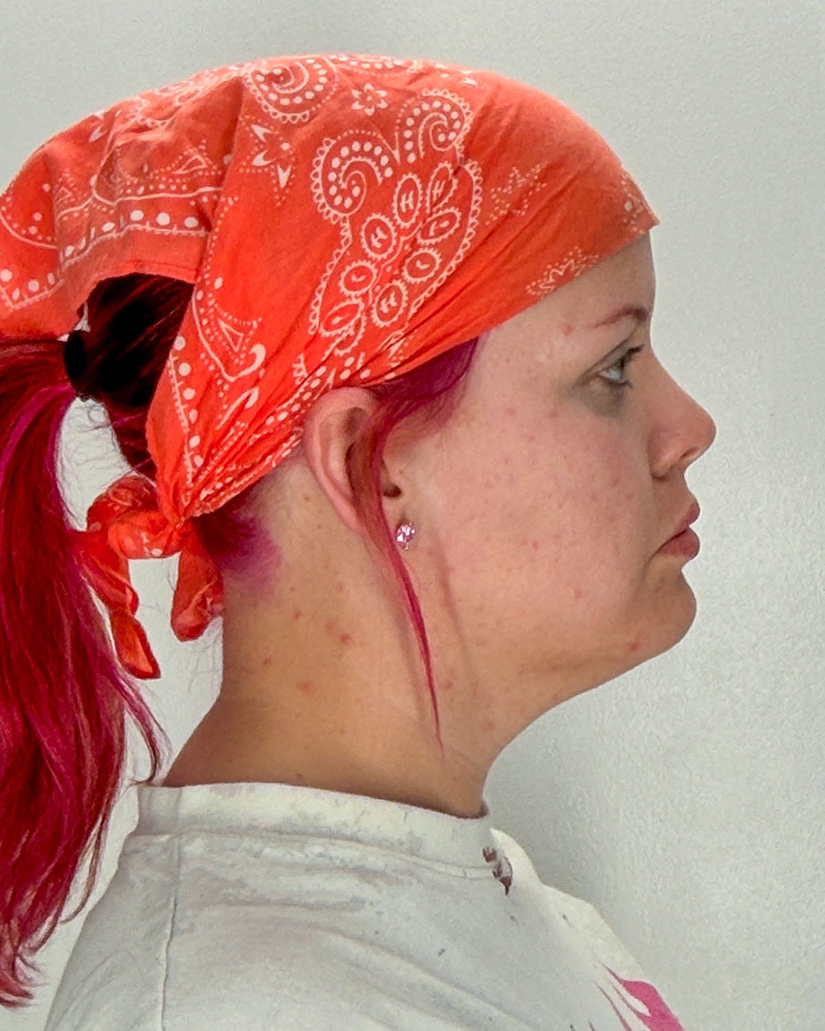 Chin Liposuction Gallery Before & After