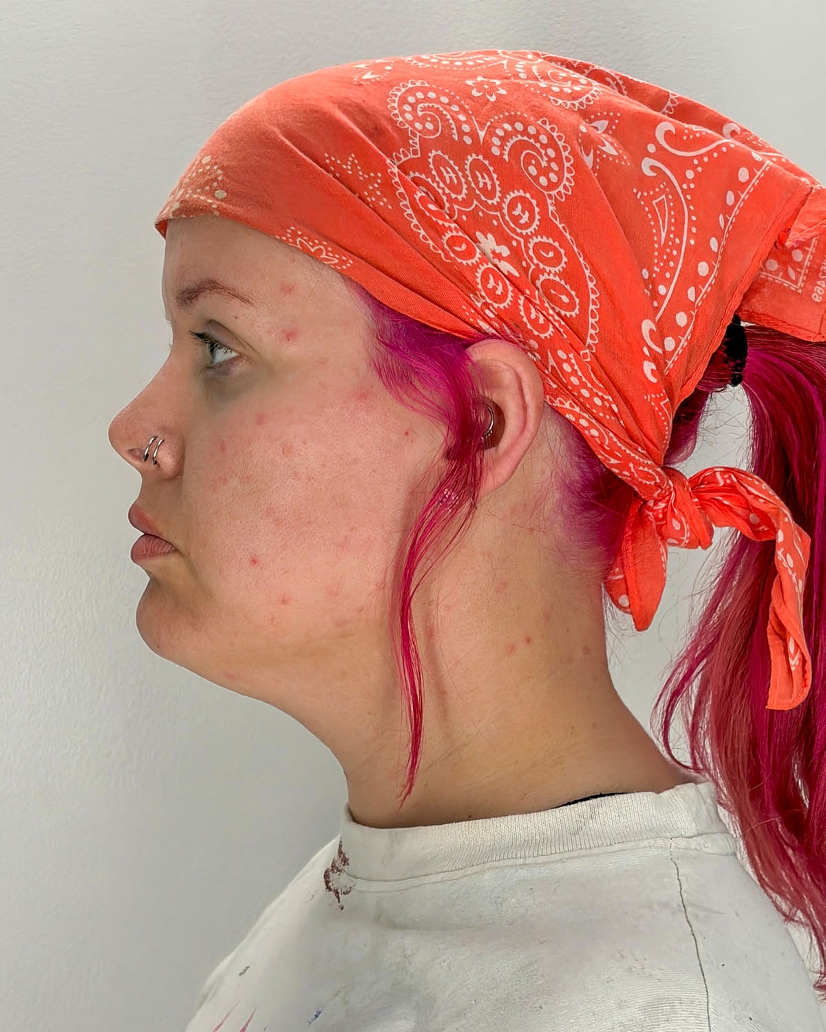 Chin Liposuction Gallery Before & After
