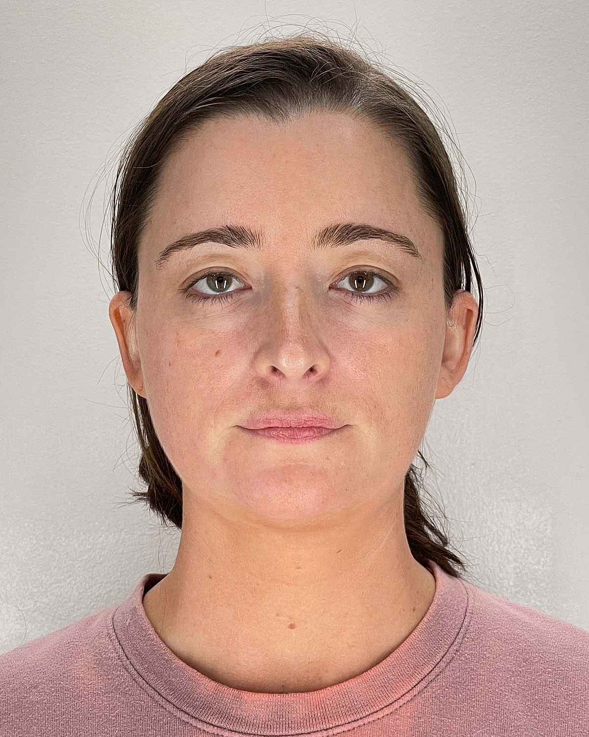 Chin Liposuction Gallery Before & After