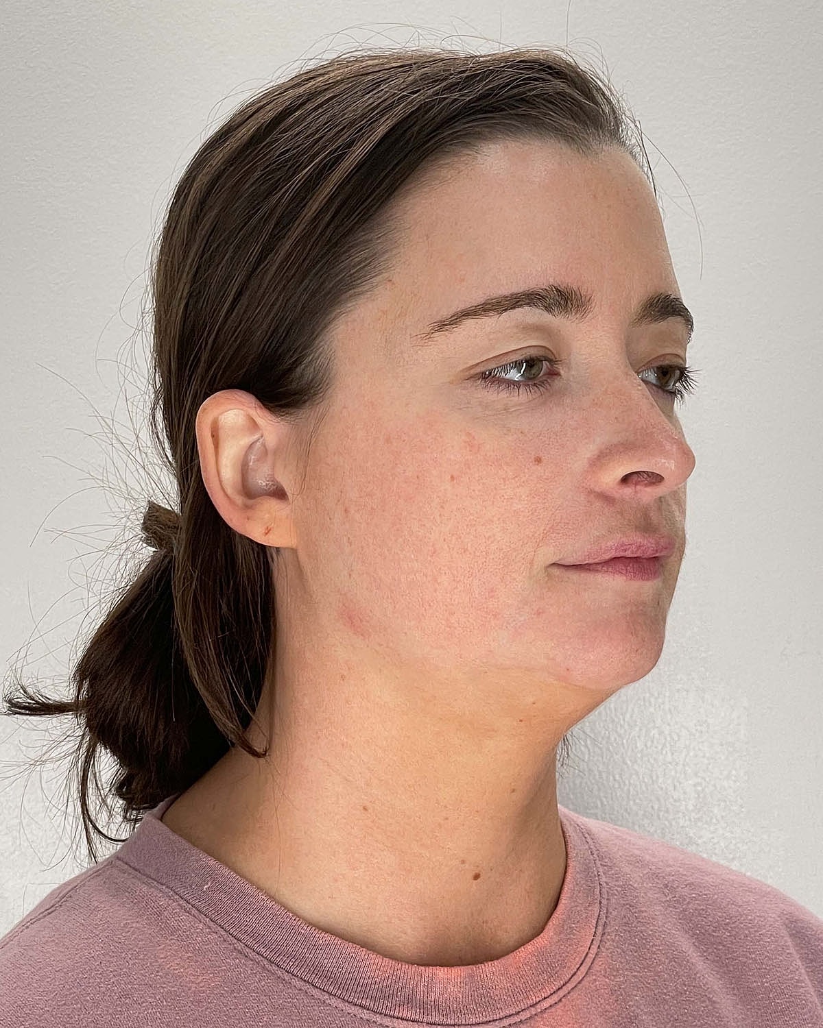 Chin Liposuction Gallery Before & After