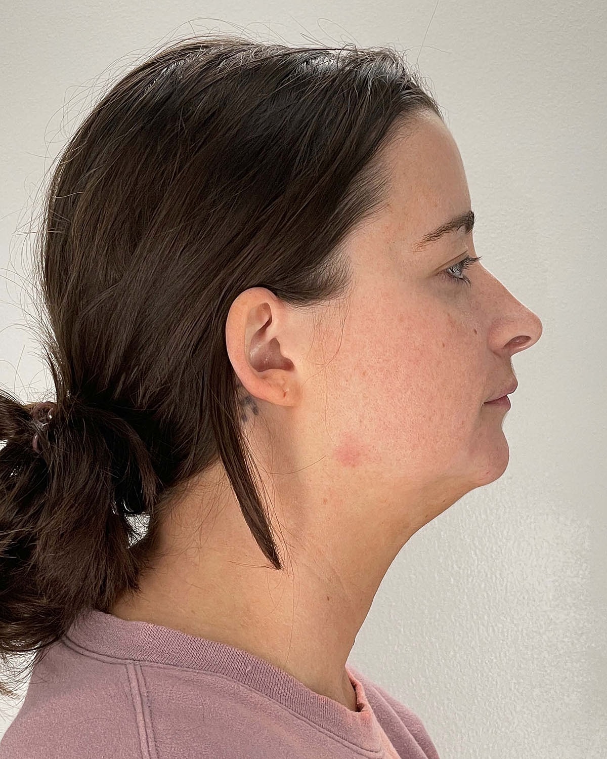 Chin Liposuction Gallery Before & After
