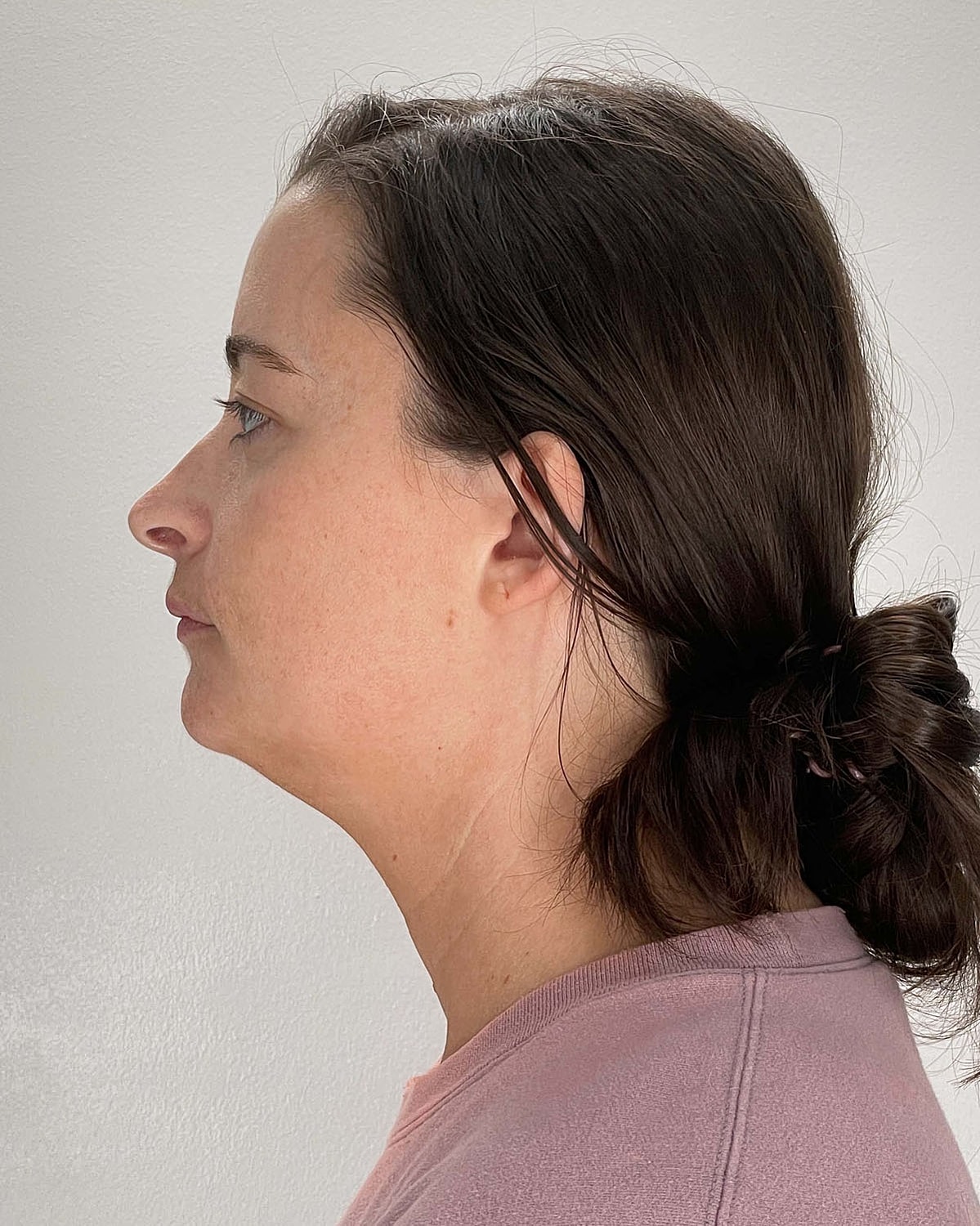 Chin Liposuction Gallery Before & After