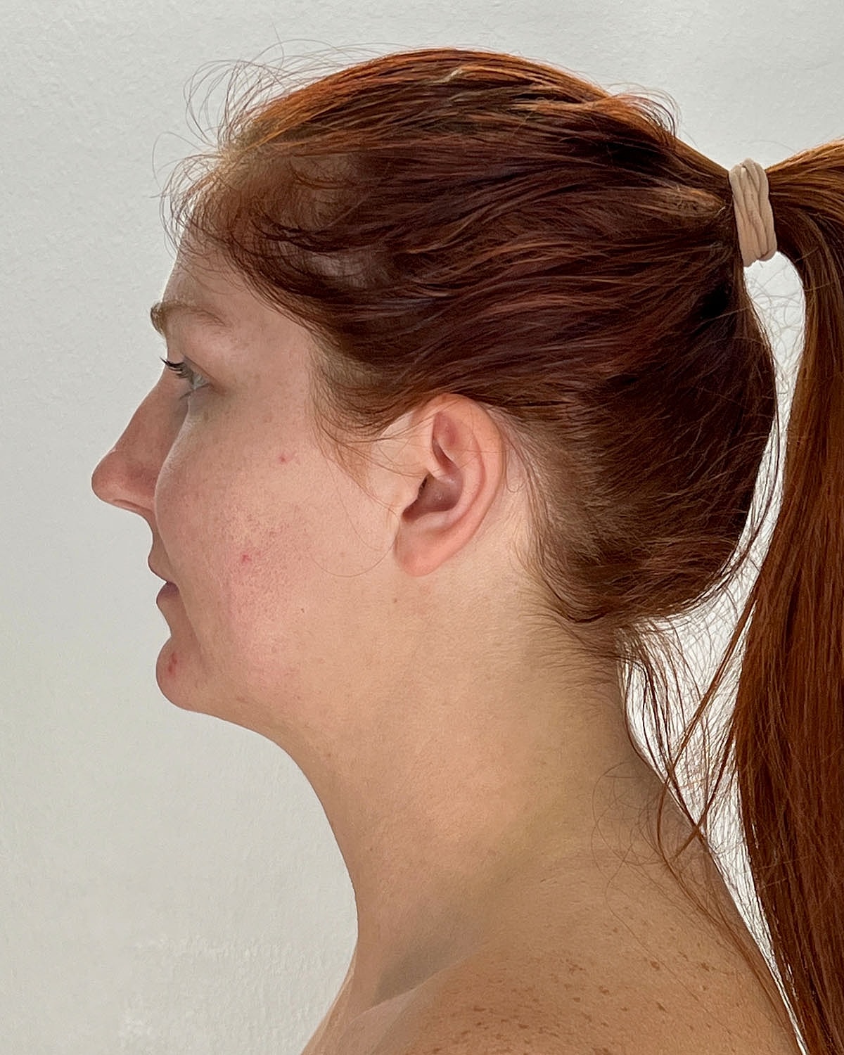 Chin Liposuction Gallery Before & After