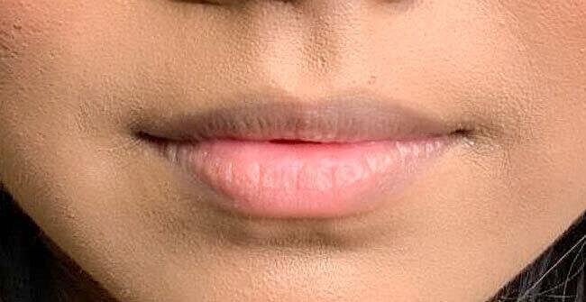 Juvederm Before & After