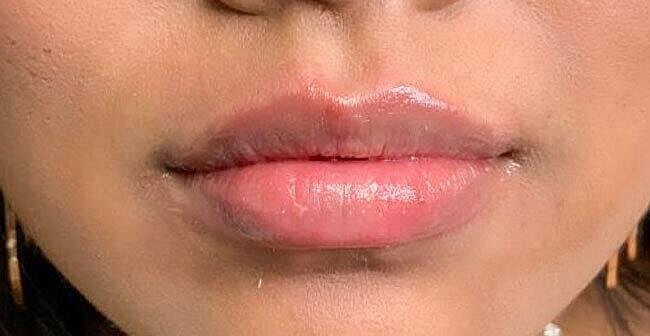 Juvederm Before & After