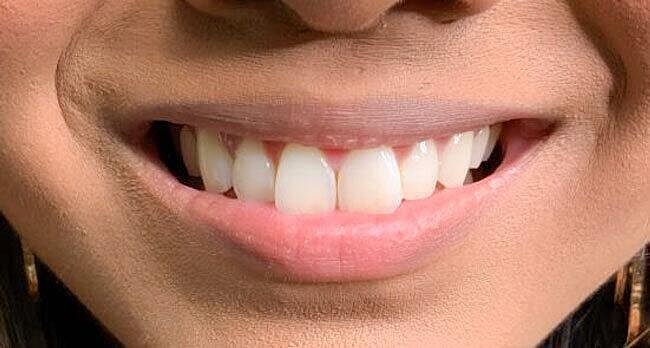 Juvederm Before & After