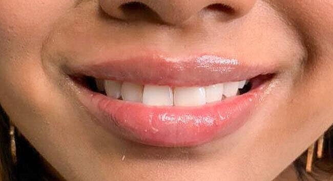 Juvederm Before & After