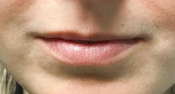 Juvederm Before & After