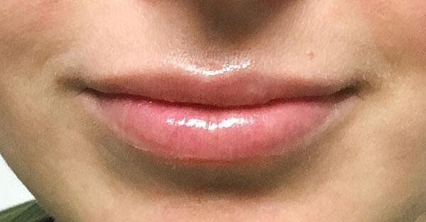 Juvederm Before & After