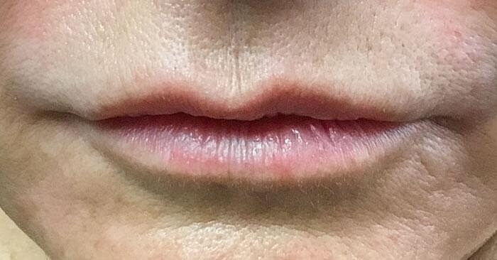 Juvederm Before & After