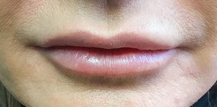 Juvederm Before & After