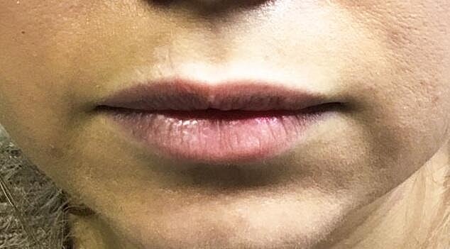 Juvederm Before & After