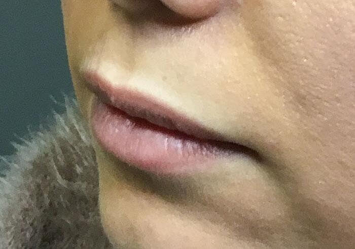 Juvederm Before & After