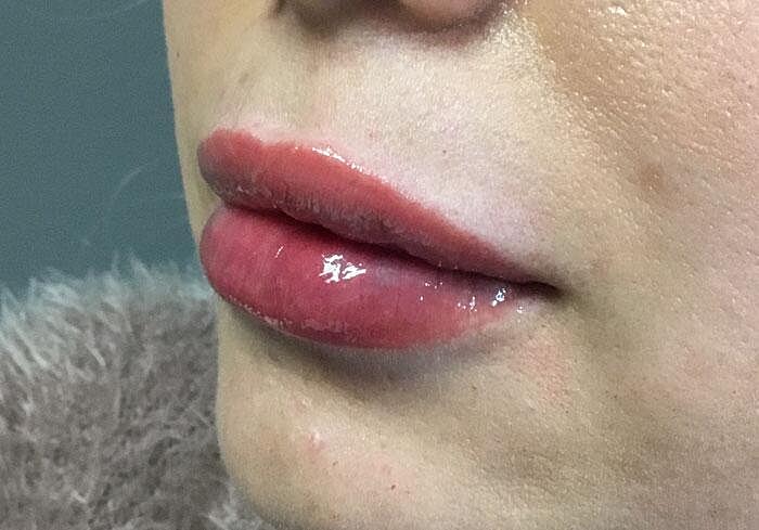 Juvederm Before & After
