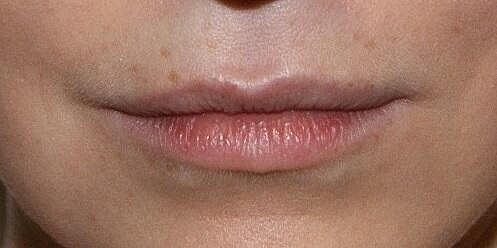 Juvederm Before & After