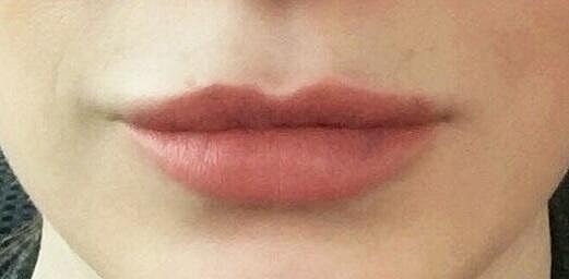 Juvederm Before & After