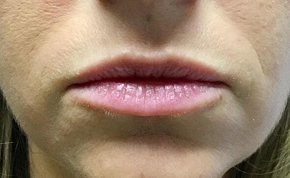 Juvederm Before & After