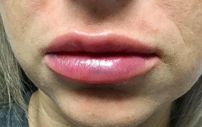 Juvederm Before & After