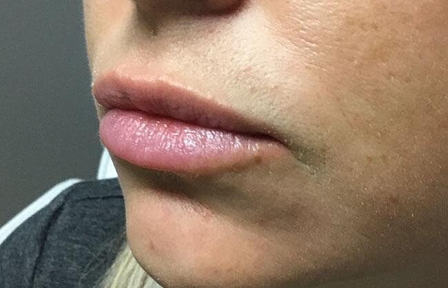 Juvederm Before & After