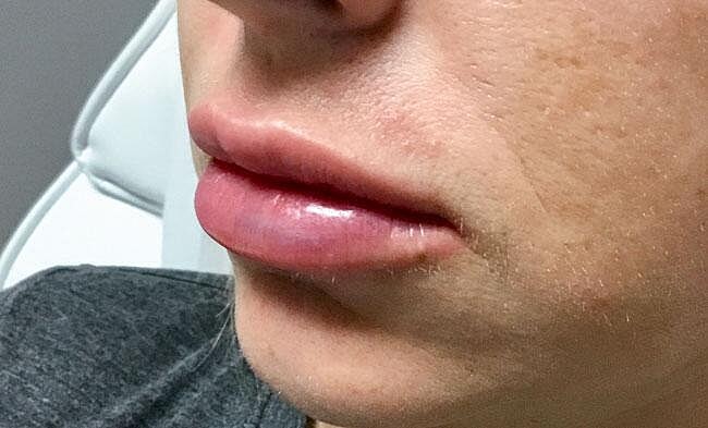 Juvederm Before & After
