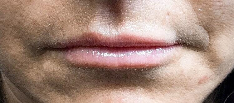 Juvederm Before & After