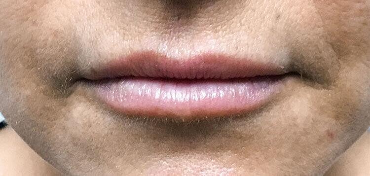 Juvederm Before & After