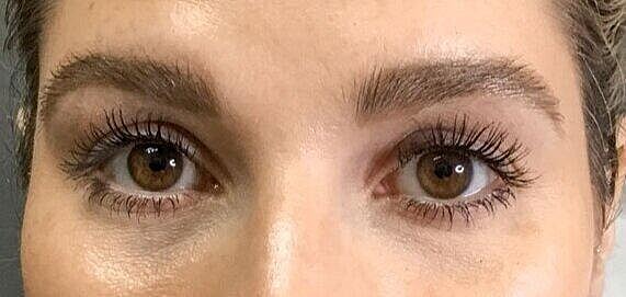 Juvederm Before & After