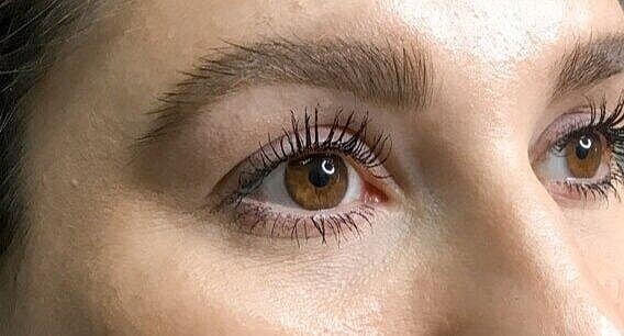 Juvederm Before & After