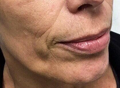 Juvederm Before & After