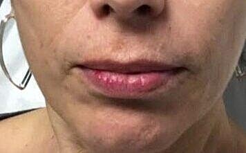 Juvederm Before & After