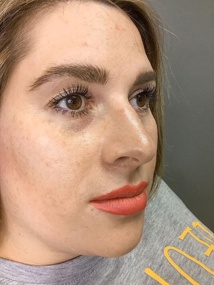 Juvederm Before & After