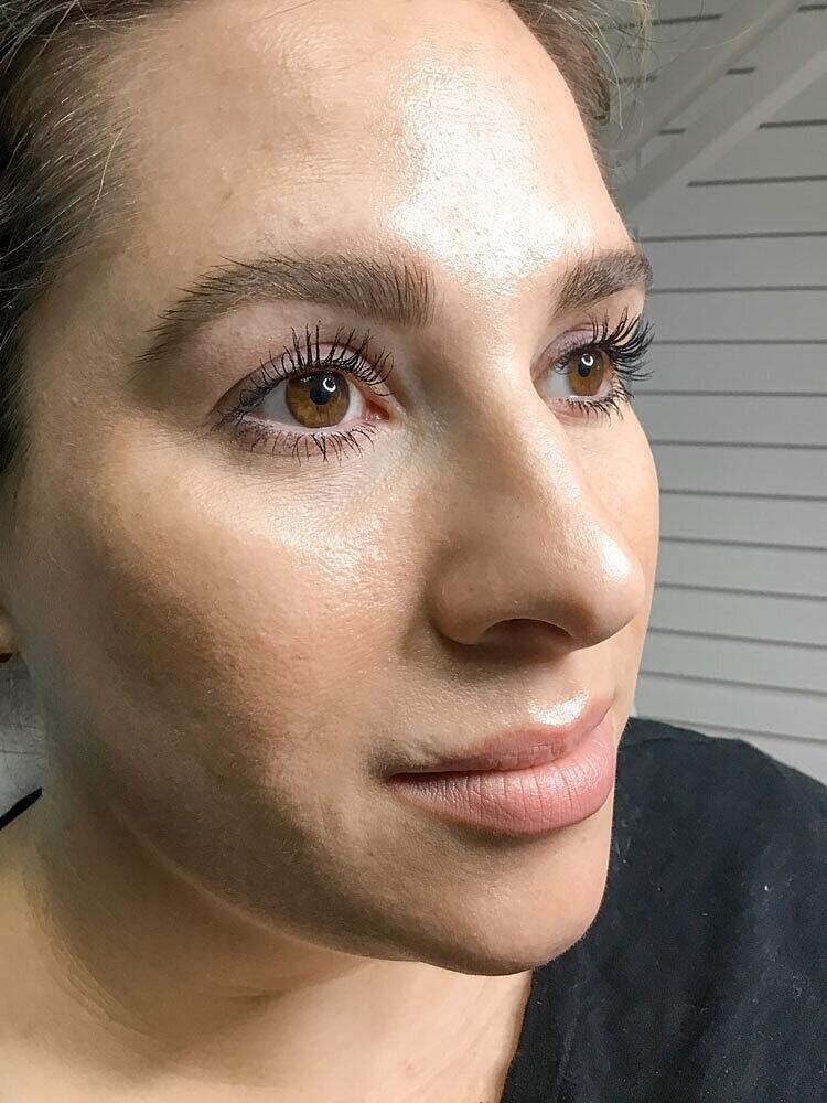 Juvederm Before & After