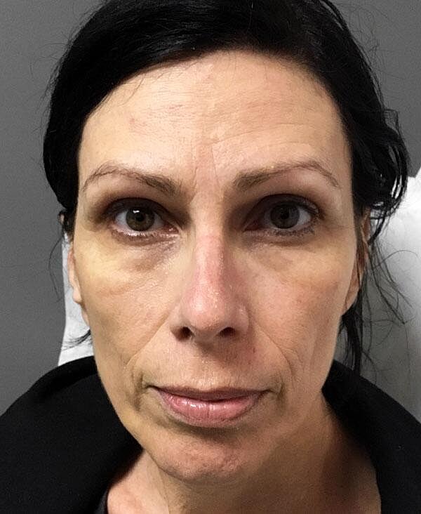 Juvederm Before & After