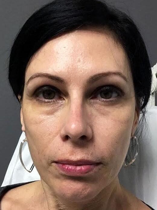 Juvederm Before & After