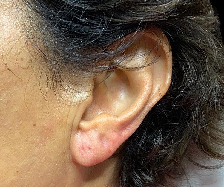 Juvederm Before & After