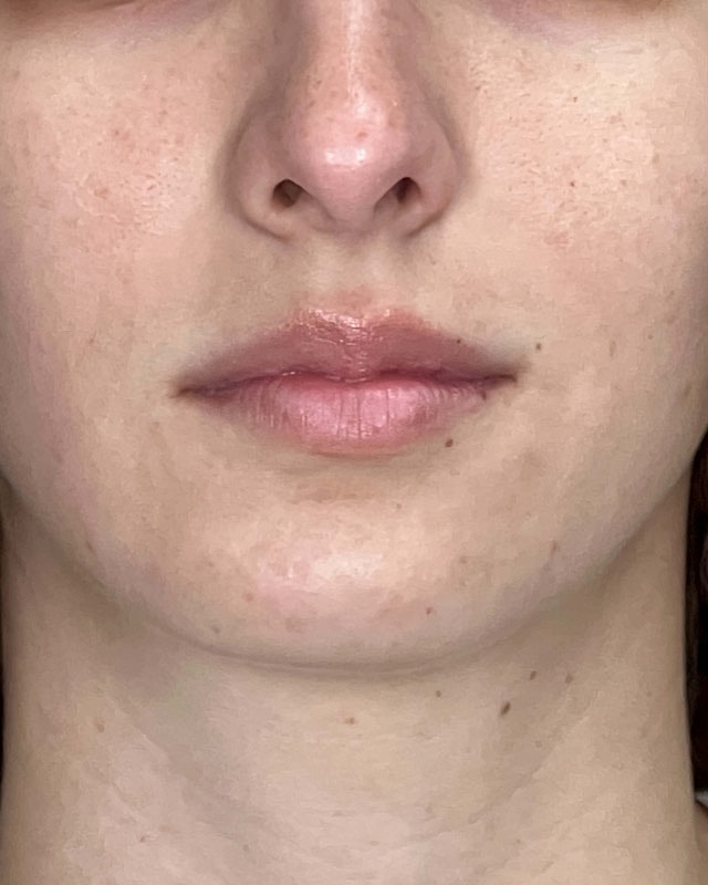 Juvederm Before & After