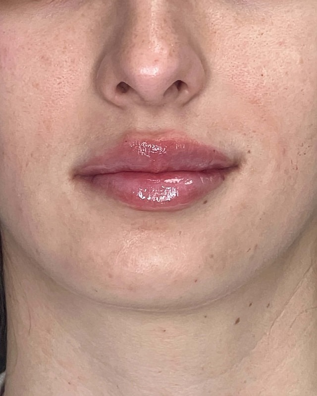 Juvederm Before & After