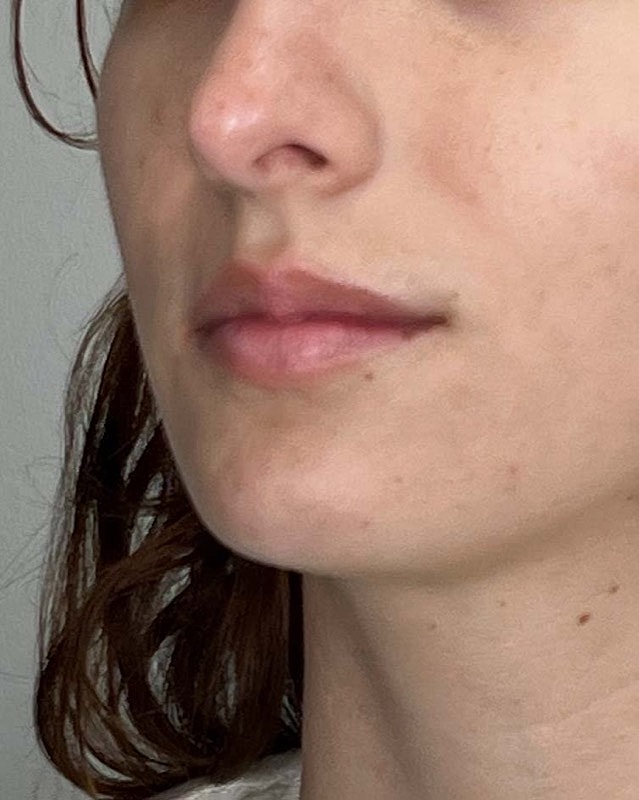 Juvederm Before & After