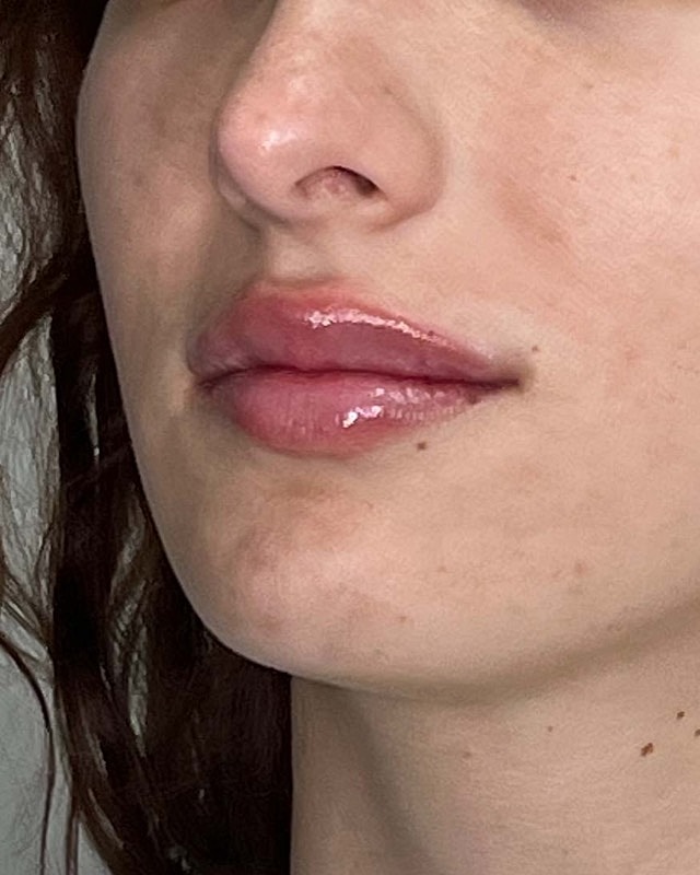 Juvederm Before & After