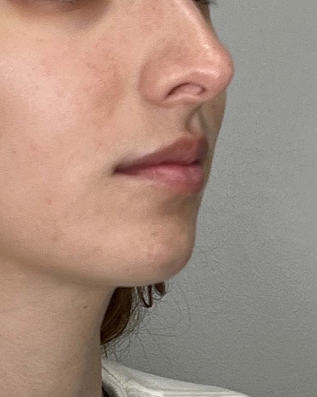 Juvederm Before & After