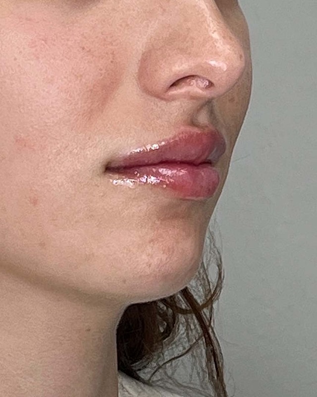 Juvederm Before & After