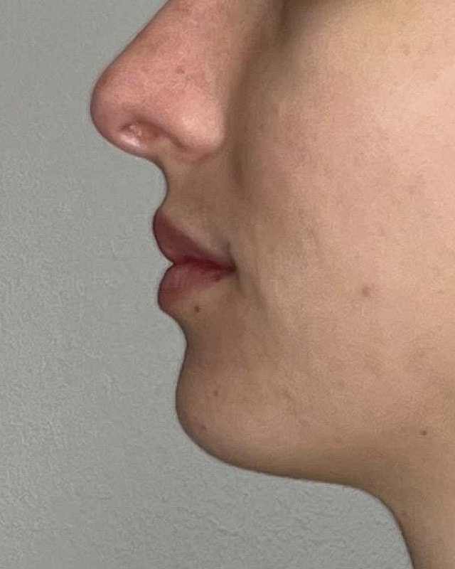 Juvederm Before & After