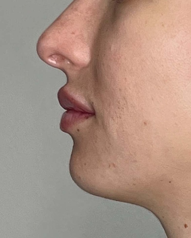 Juvederm Before & After
