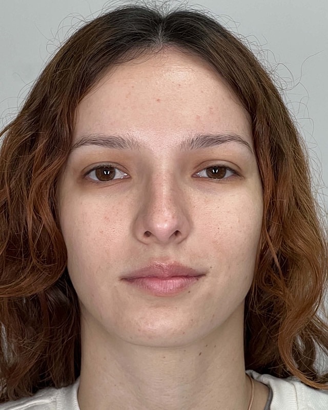 Juvederm Before & After