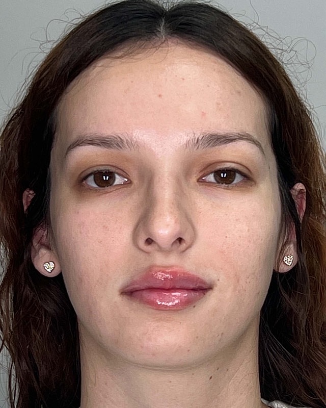 Juvederm Before & After