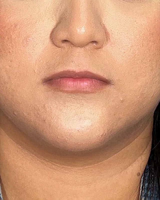 Juvederm Before & After