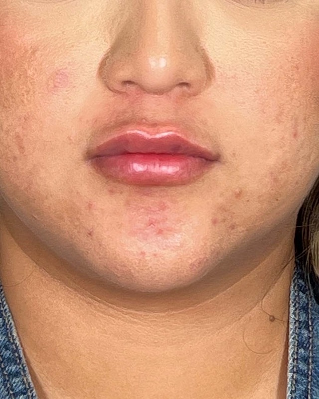 Juvederm Before & After
