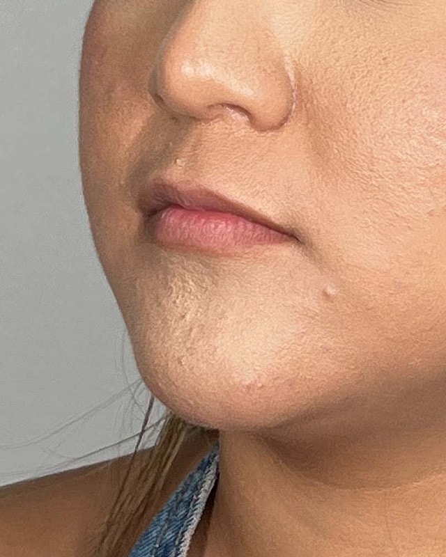 Juvederm Before & After
