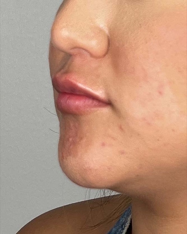 Juvederm Before & After