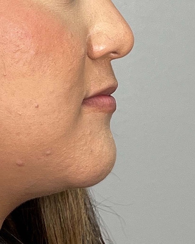 Juvederm Before & After